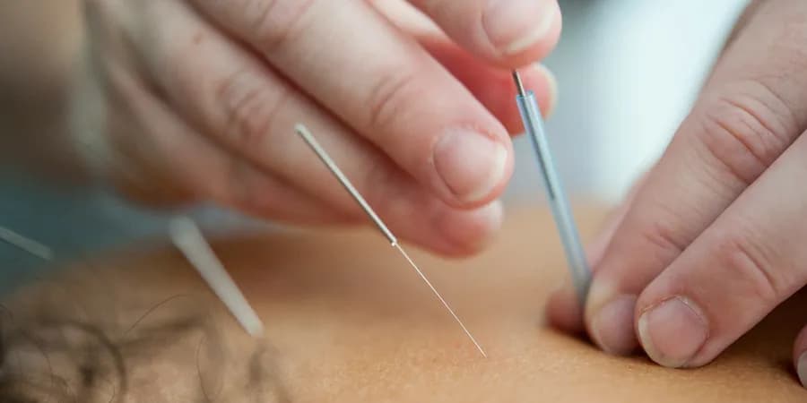 Dry needling