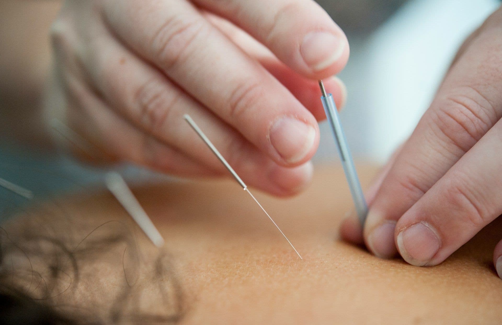 Dry needling